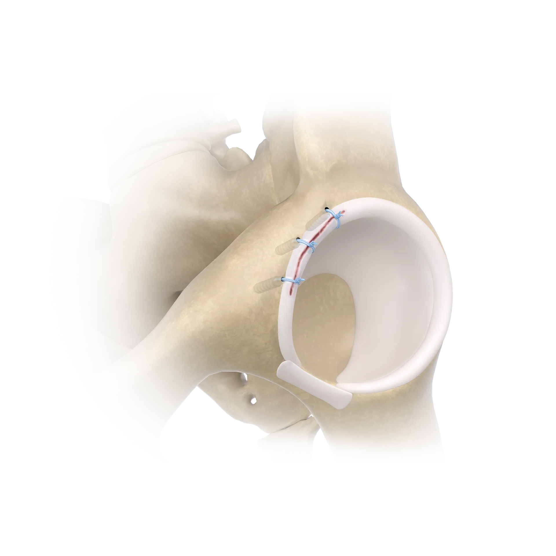 SSH27-髋关节盂唇撕裂修复术-Labral Tear Repair.png