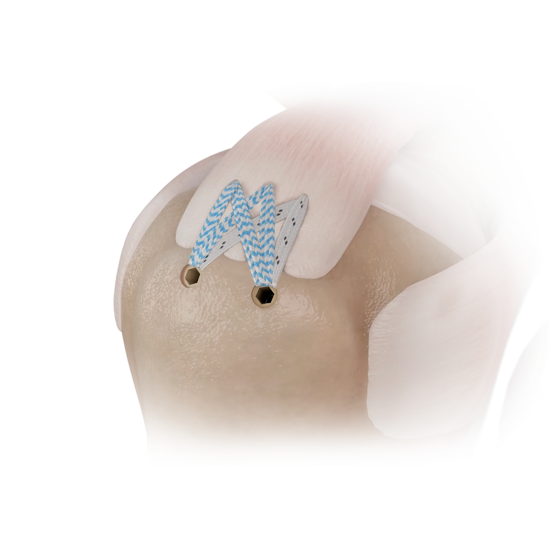 SSH03 全缝线锚钉+免打结锚钉双排缝合修复术DOUBLE-ROW REPAIR WITH ALL-SUTURE ACHOR AND KNOTLESS ANCHOR.png
