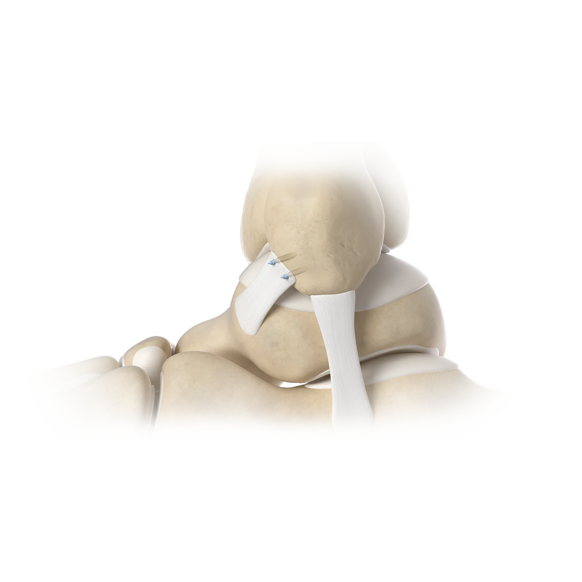 SSH25-原位修复术-In-situ Repair Surgery.png