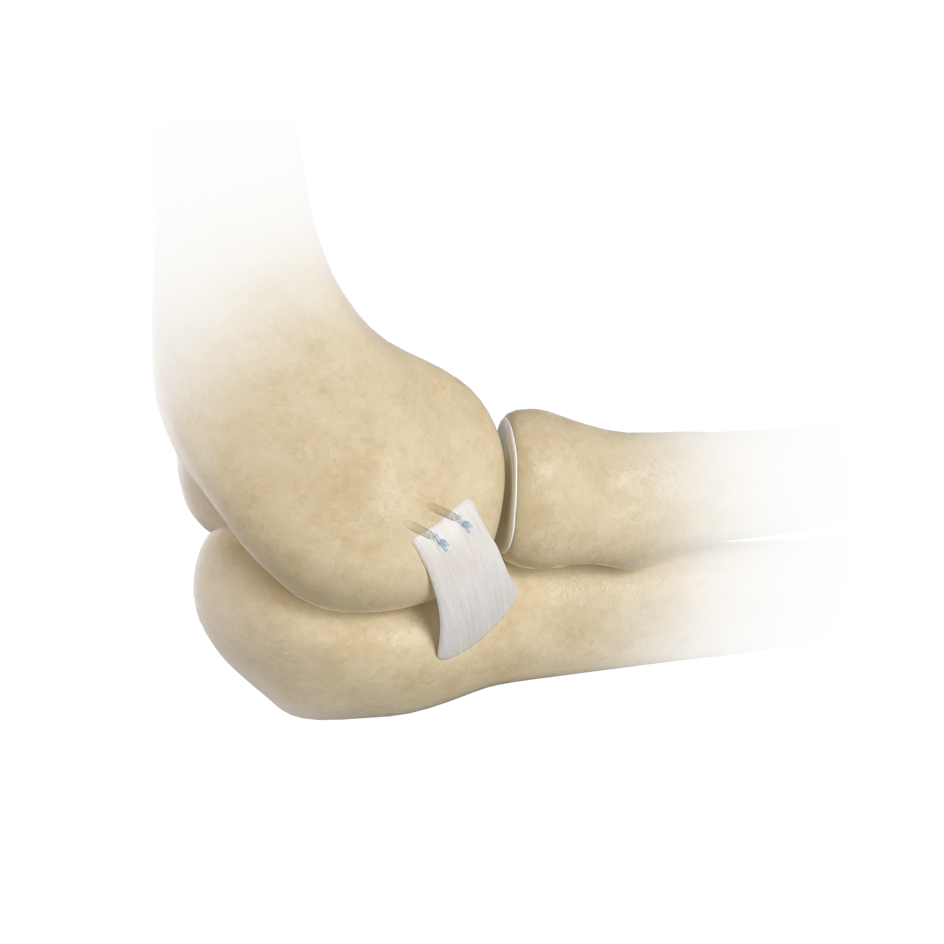 SSH28-侧副韧带撕裂修复术-Collateral Ligament Tear Repair.png