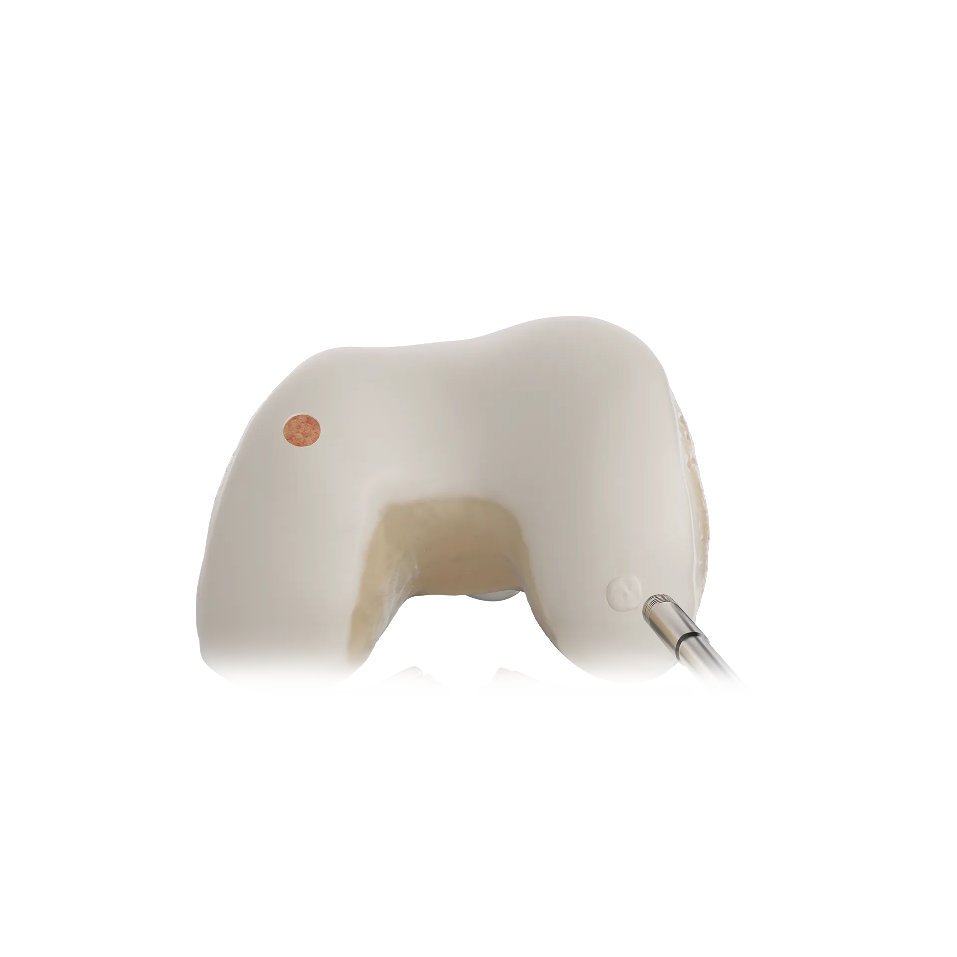 SSH19-软骨移植手术-Cartilage Transplant.png