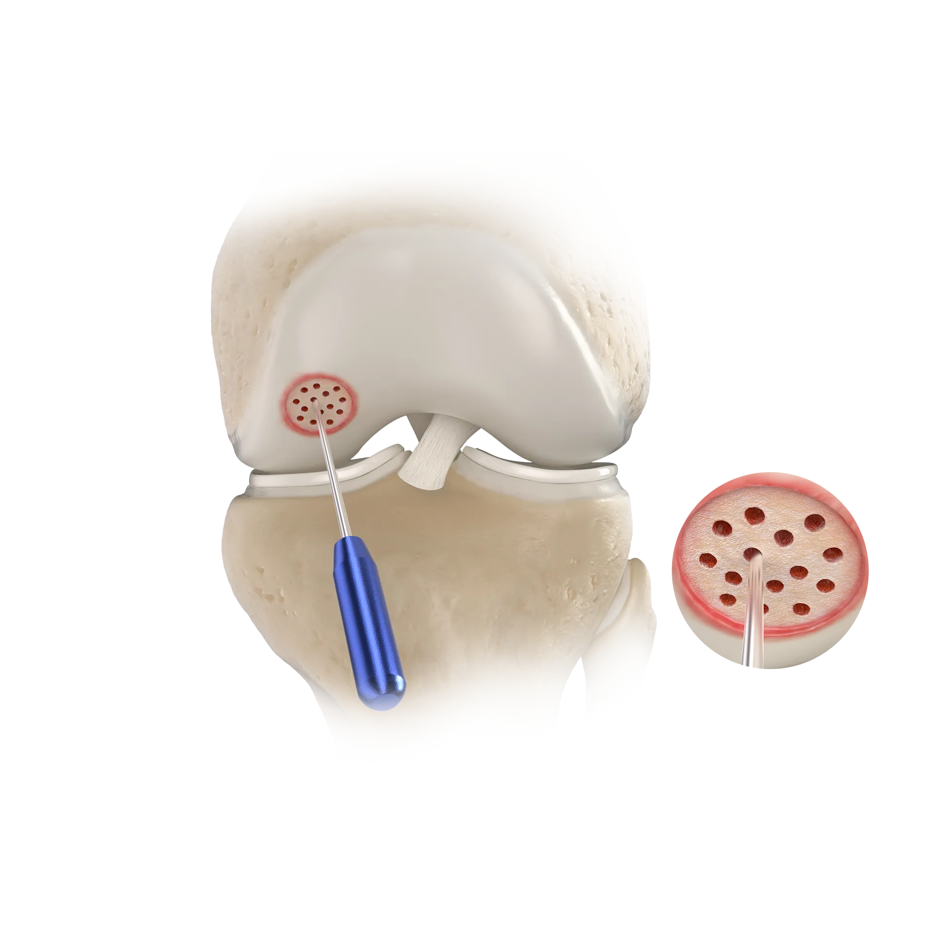 SSH18-微骨折手术-Microfracture Surgery.png