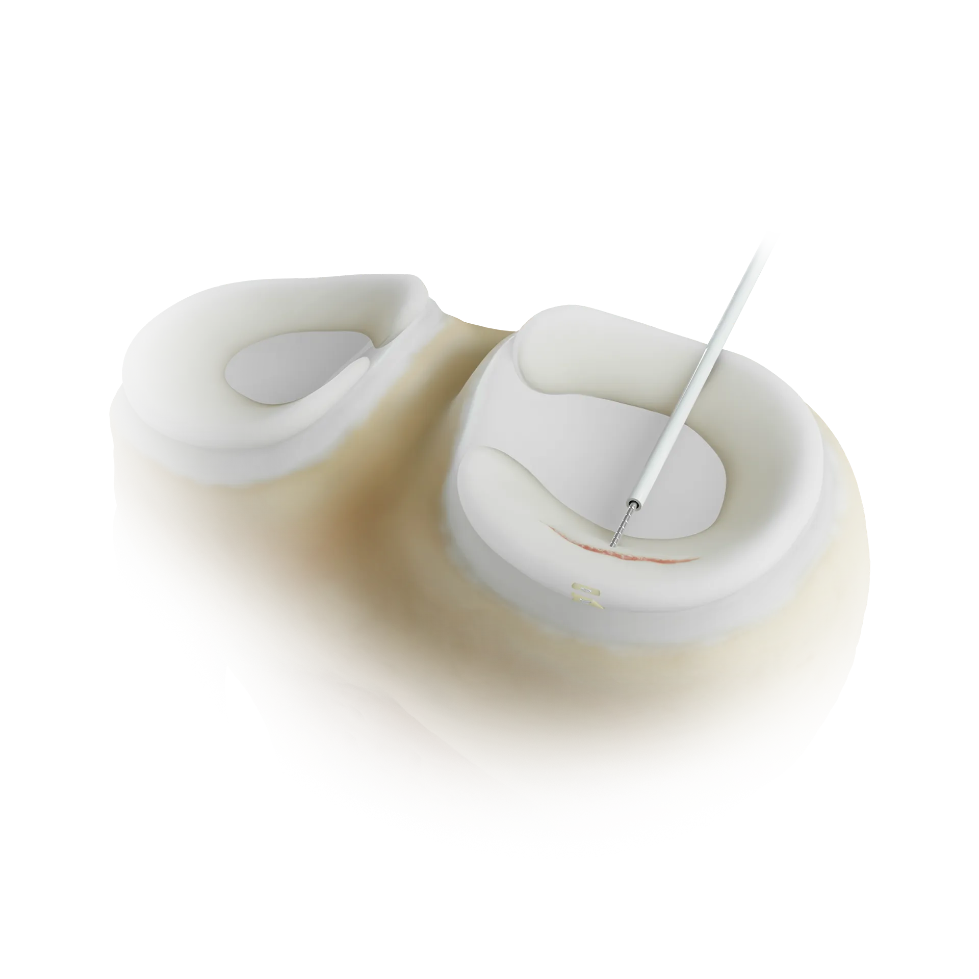 SSH14-全内缝合器修复半月板后角ALL-INSIDE MENISCAL REPAIR OF POSTERIORMENISCUS.png