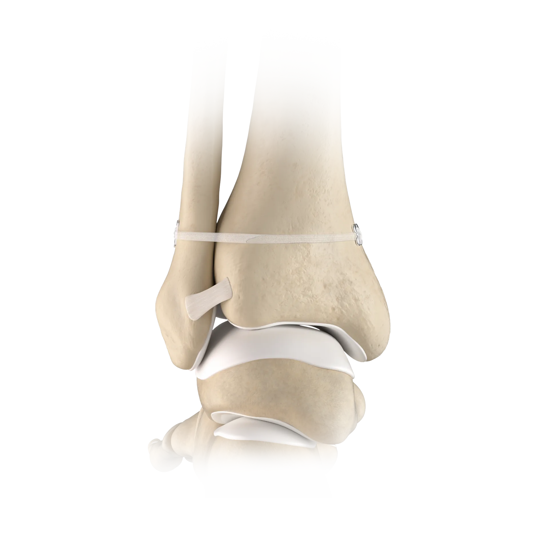 SSH21-MPFL重建术-MPFL Reconstruction.png