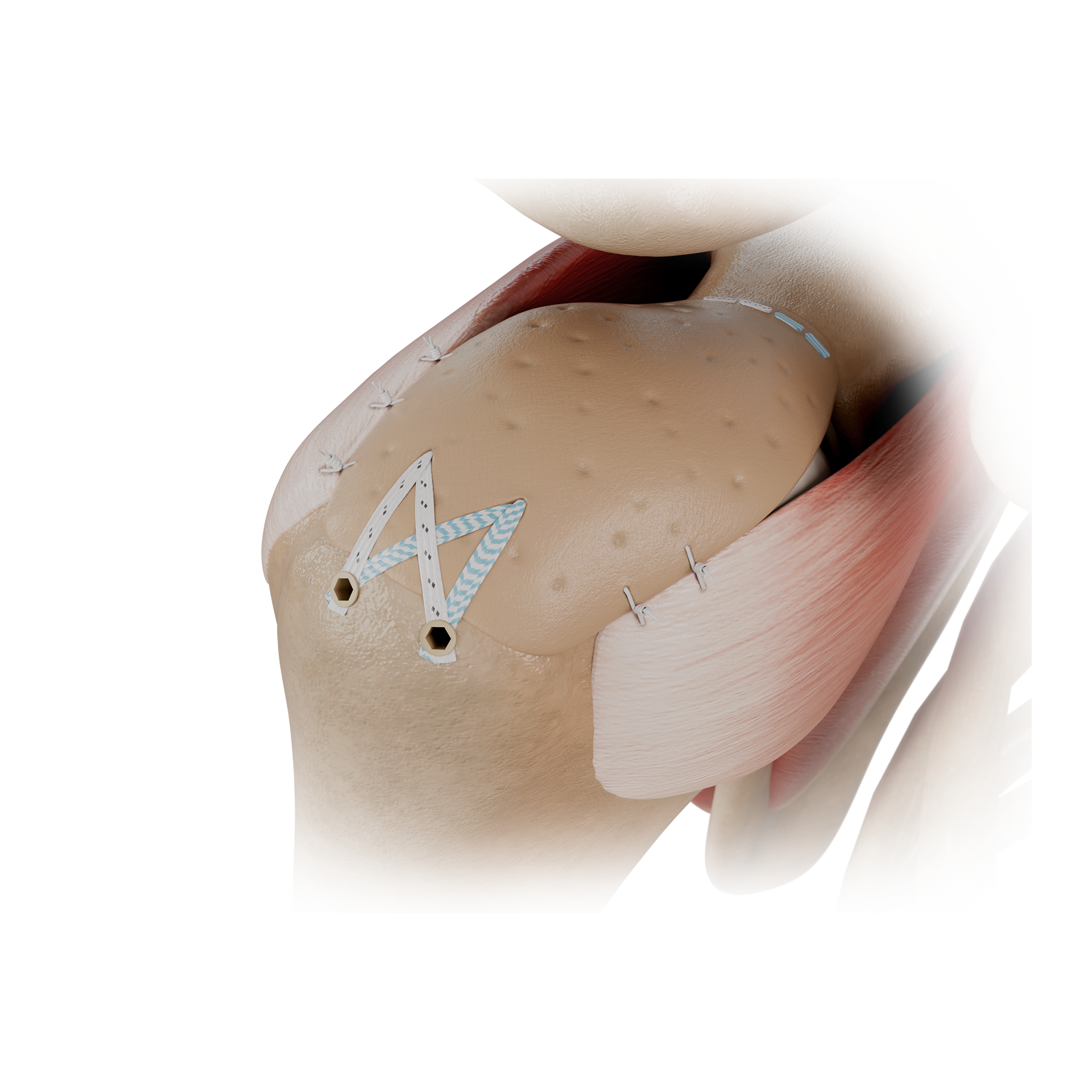 SSH04 上关节囊重建术SUPERIORCASPULE RECONSTRUCTION.png