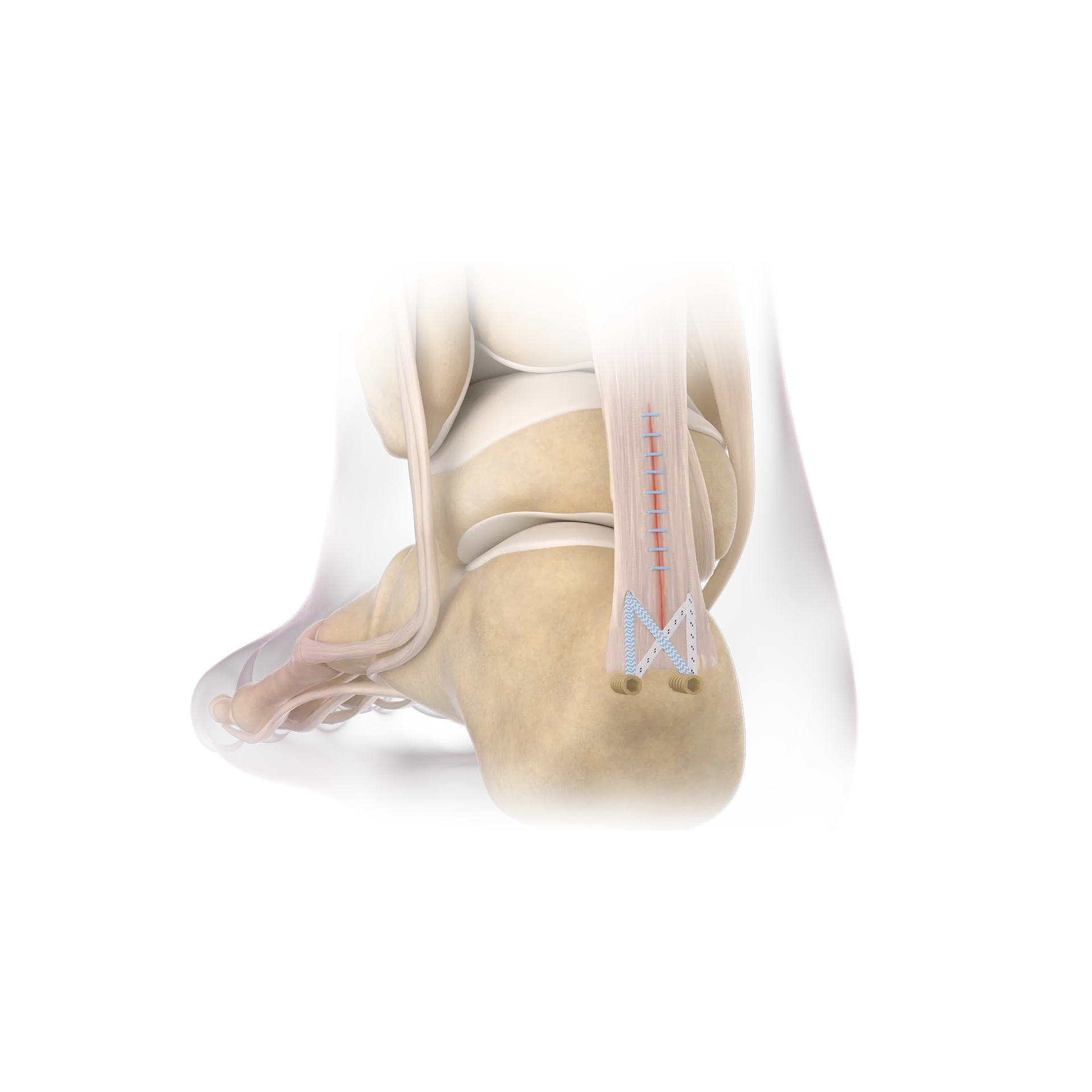 SSH24-跟腱止点断裂修复术-Achilles Tendo Attachment Site Rupture Repair.png