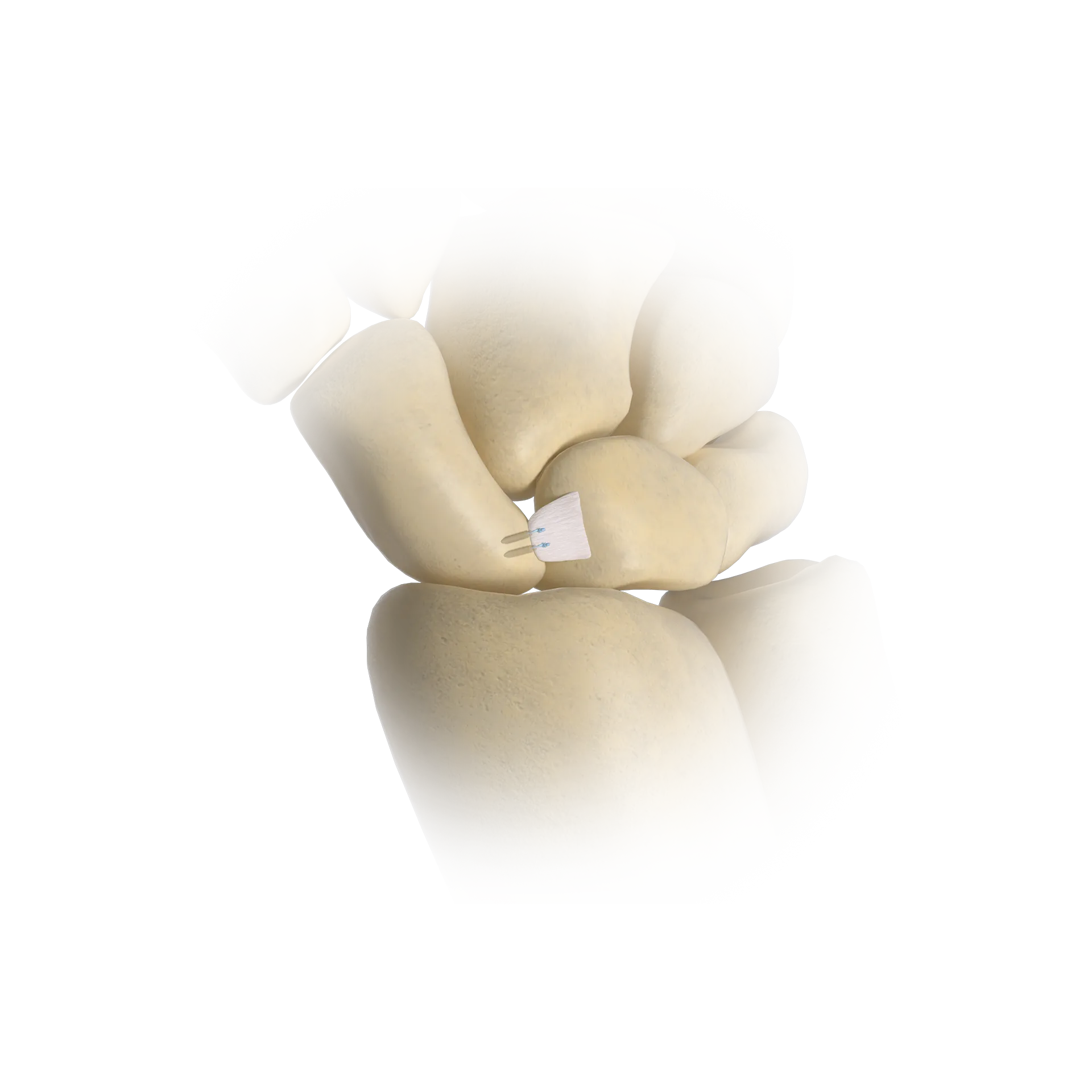 SSH30-Scapholunate Ligament Injury Repair.png