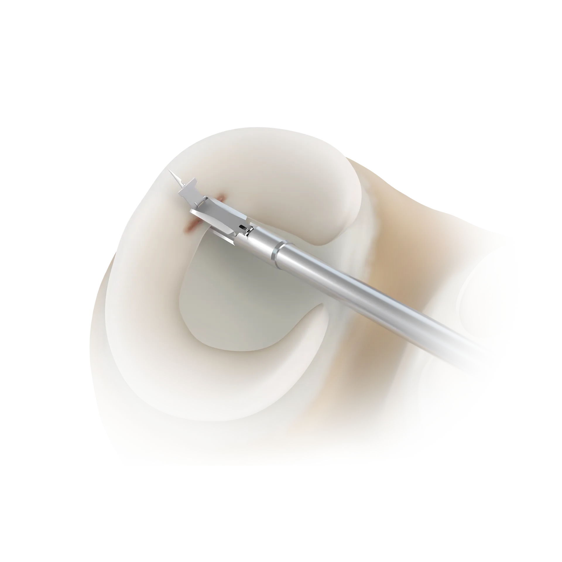 SSH13-全内修复半月板体部-ALL-INSIDE MENISCAL BODY REPAIR.png