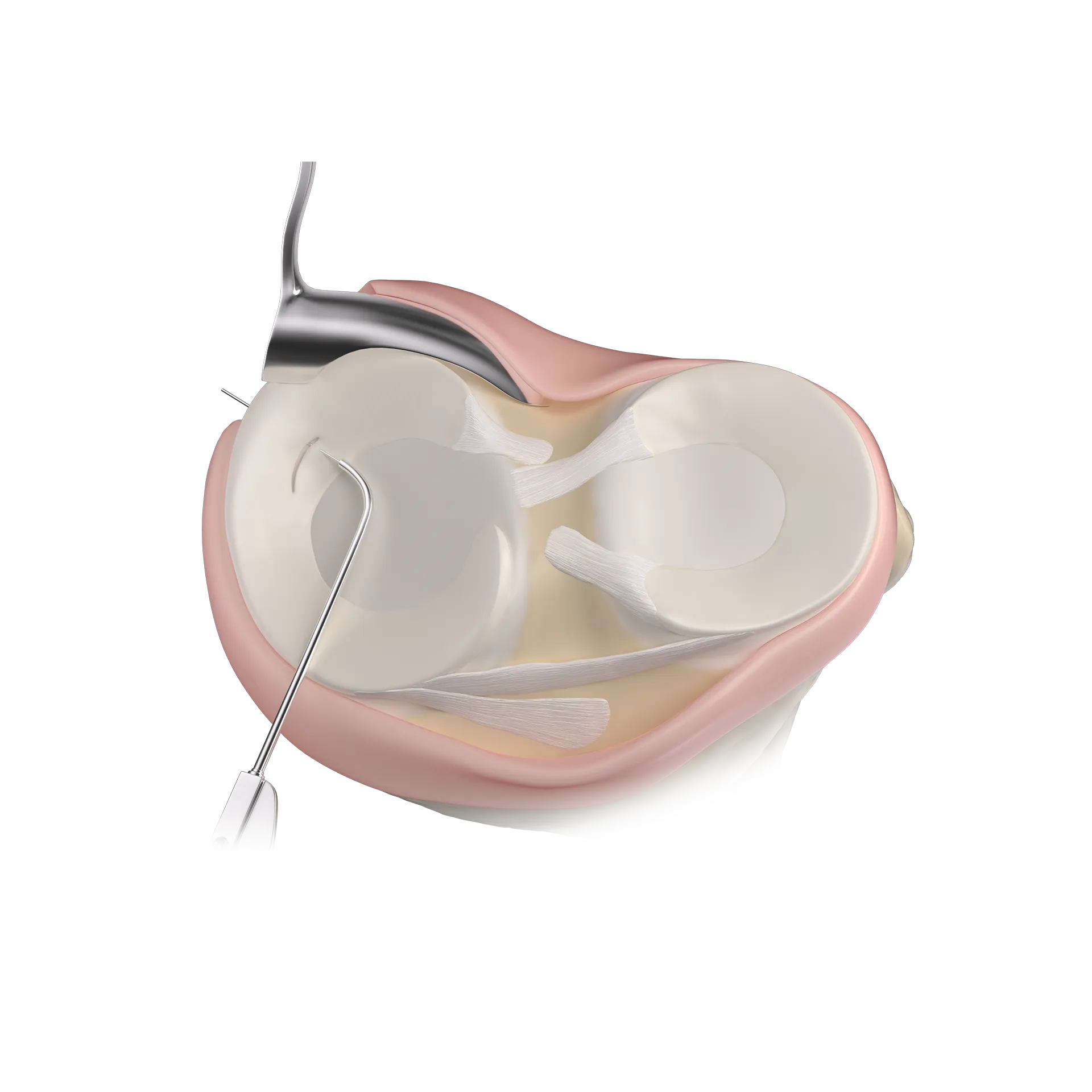SSH15-由内向外技术修复半月板前后角-Inside-out Meniscal Posterior Horn Repair.png