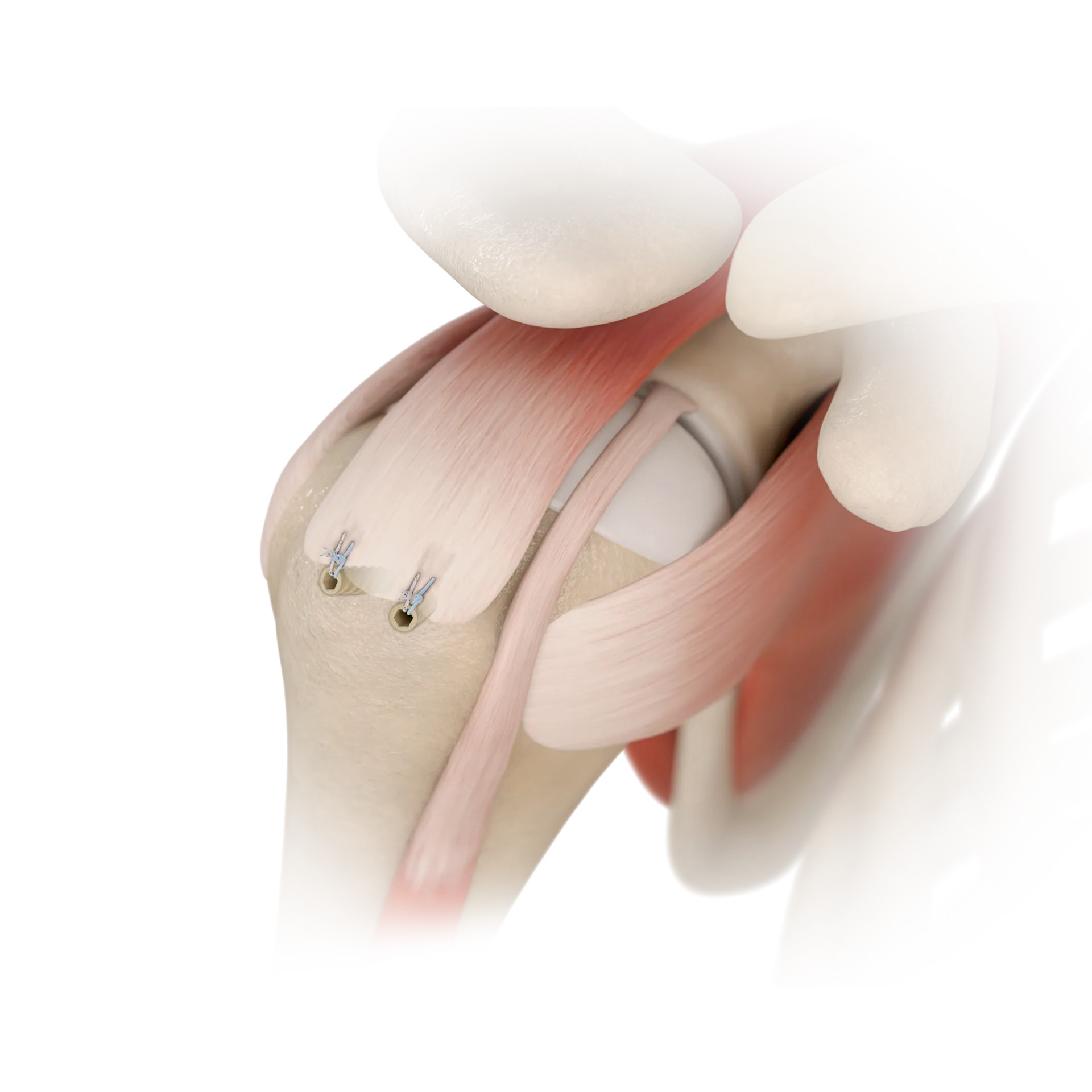 SSH01-单排肩袖修复术SINGLE-ROW REPAIR.png