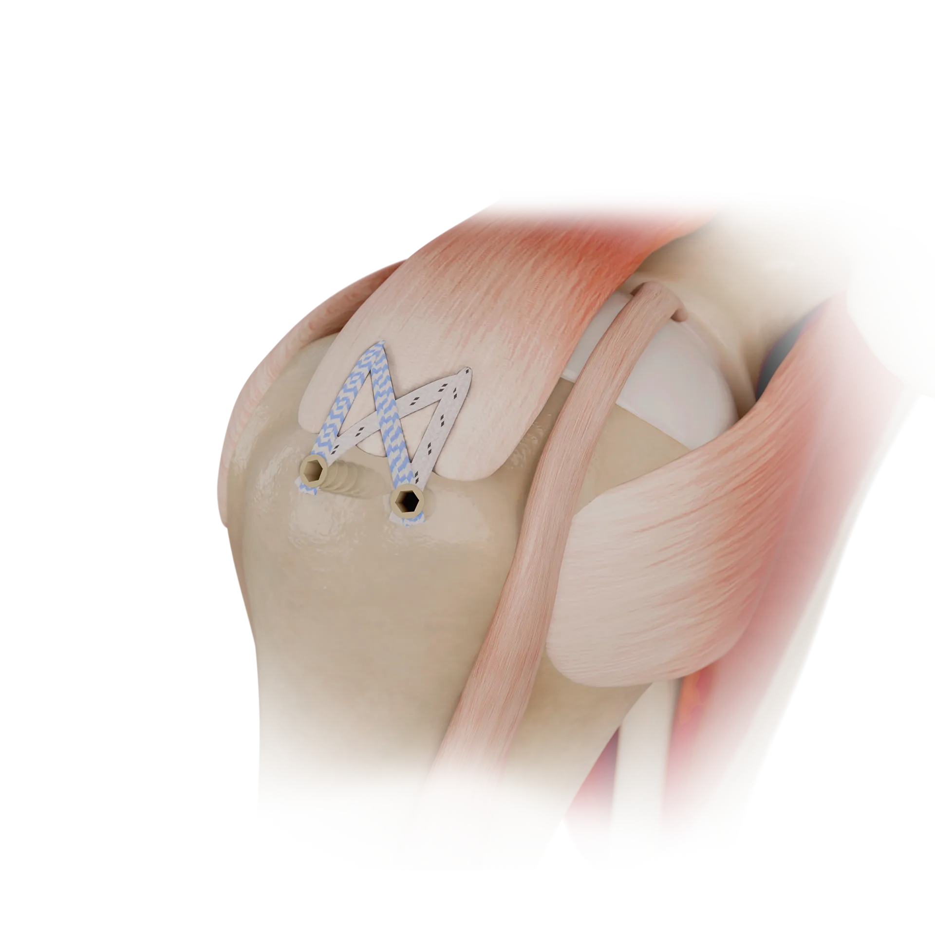 SSH02-PEEK锚钉+免打结锚钉双排缝合修复术DOUBLE-ROW REPAIR WITH PEEK ANCHORAND KNOTLESS ANCHOR.png