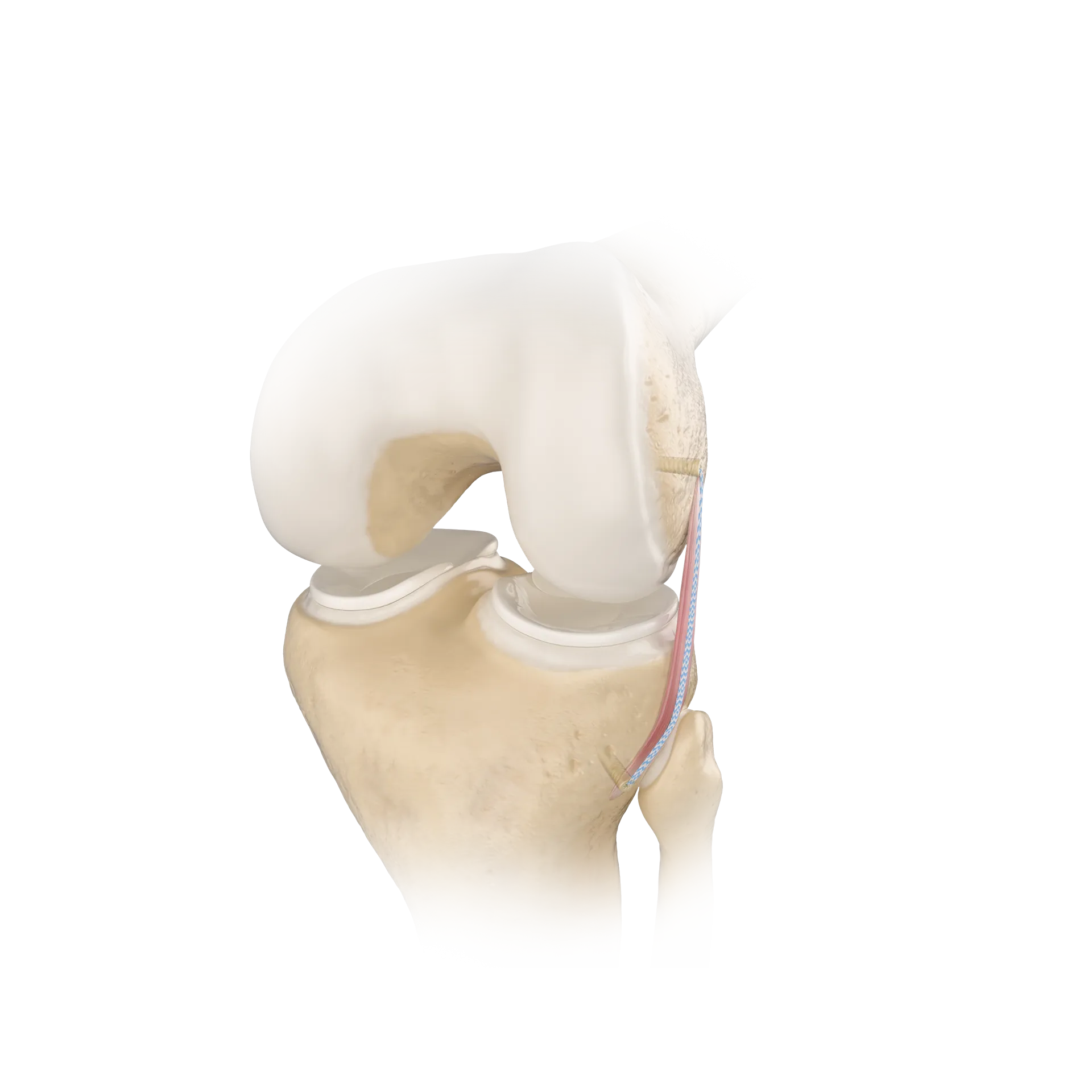 SSH20-内侧副韧带修复术-Collateral Ligament Reconstruction.png