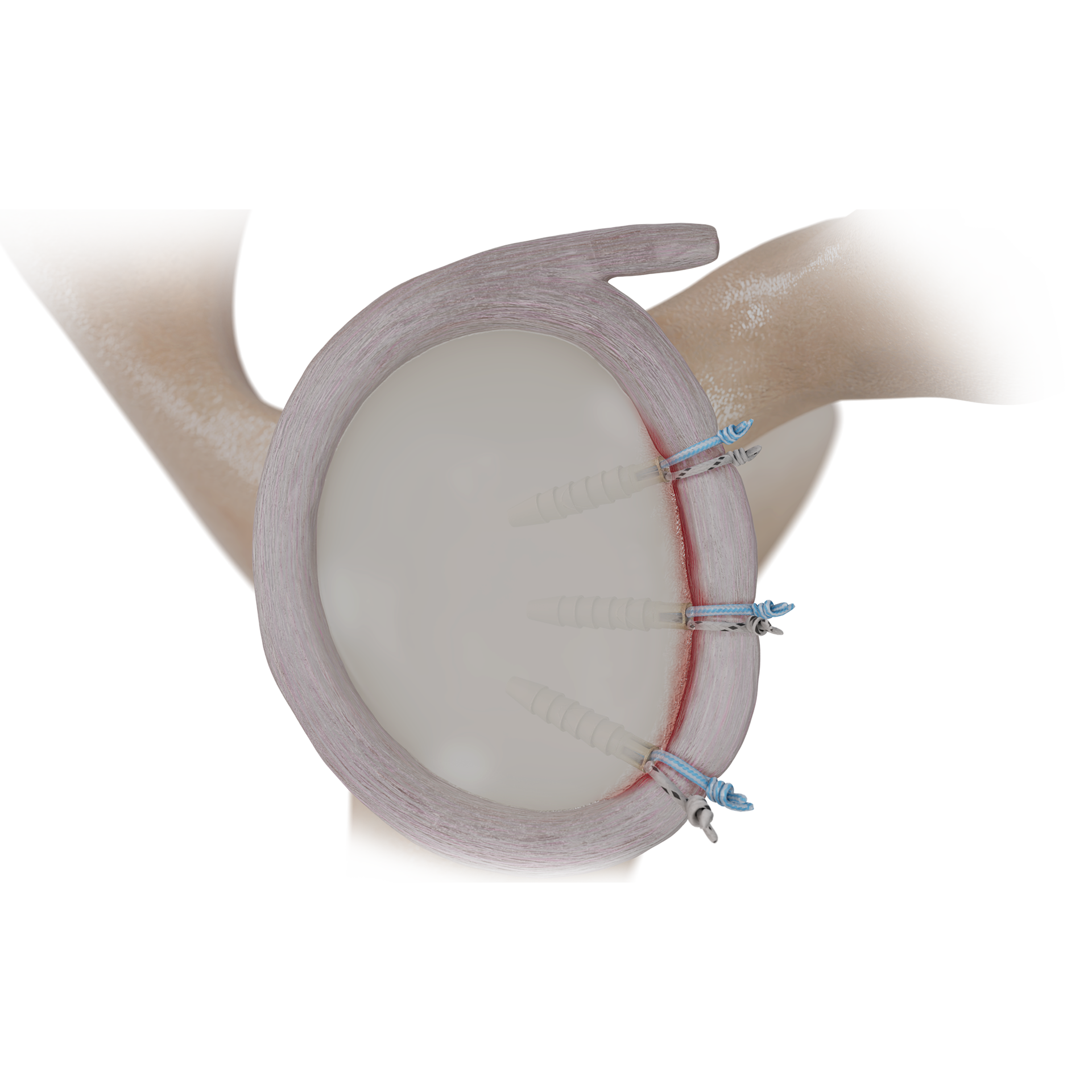 SSH05-PEEK带线锚钉肩不稳修复术PEEK SUTURE ANCHOR REPAIR FORSHOULDER INSTABILITY.png