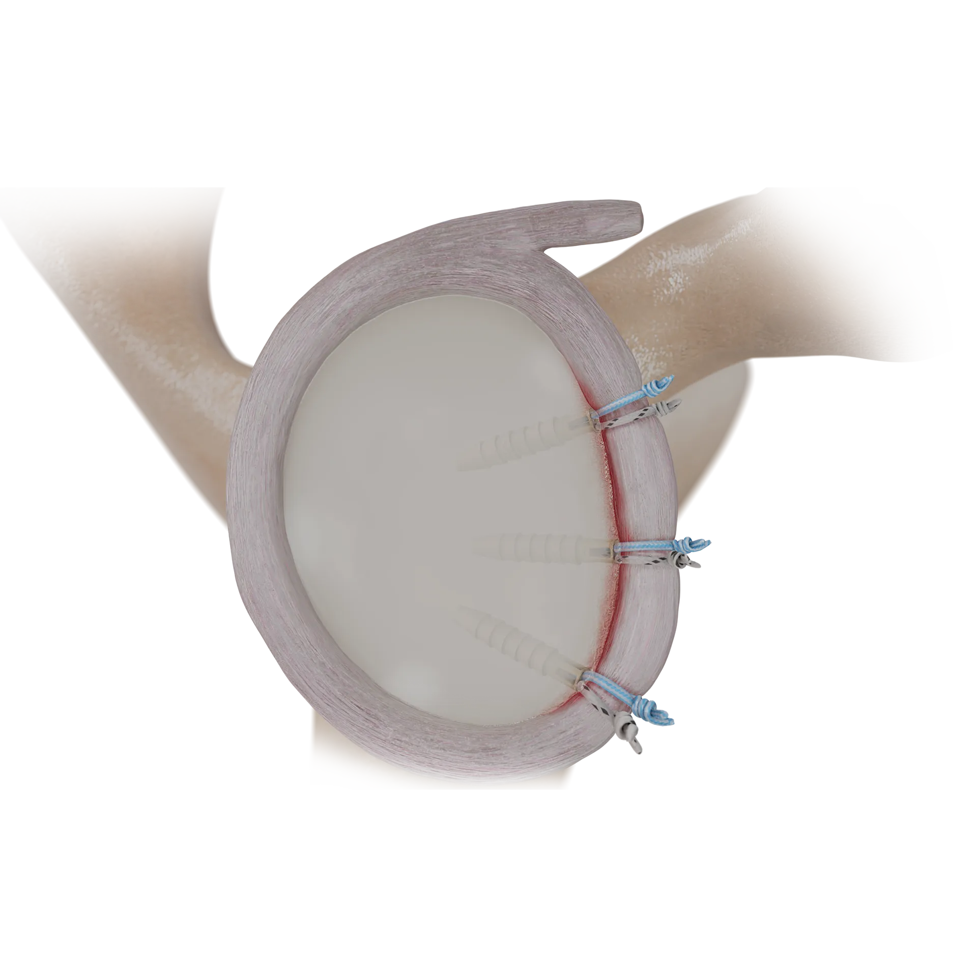 SSH05-PEEK带线锚钉肩不稳修复术PEEK SUTURE ANCHOR REPAIR FORSHOULDER INSTABILITY.png