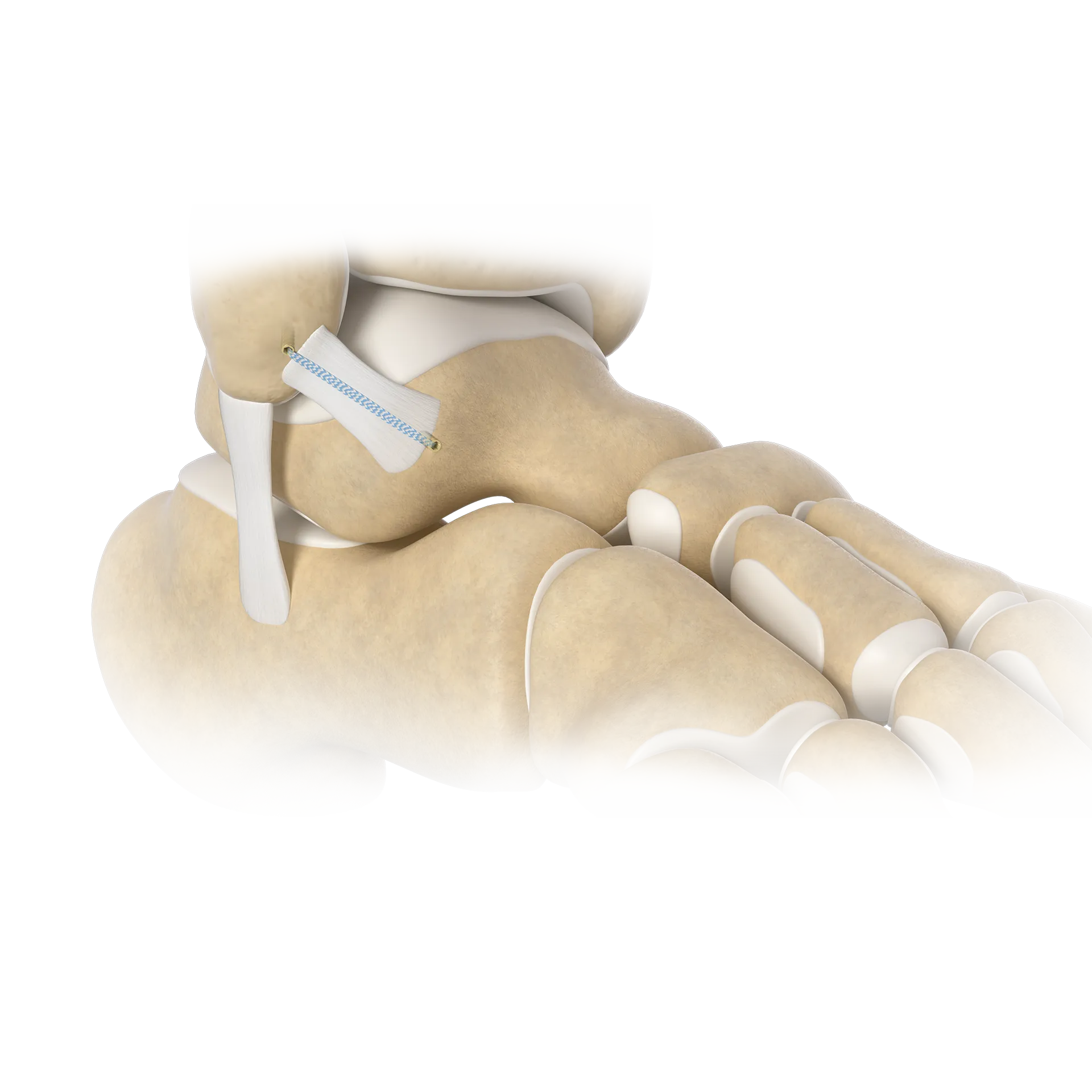 SSH26-Reconstrucción del Ligamento Reconstruction-Ligament .