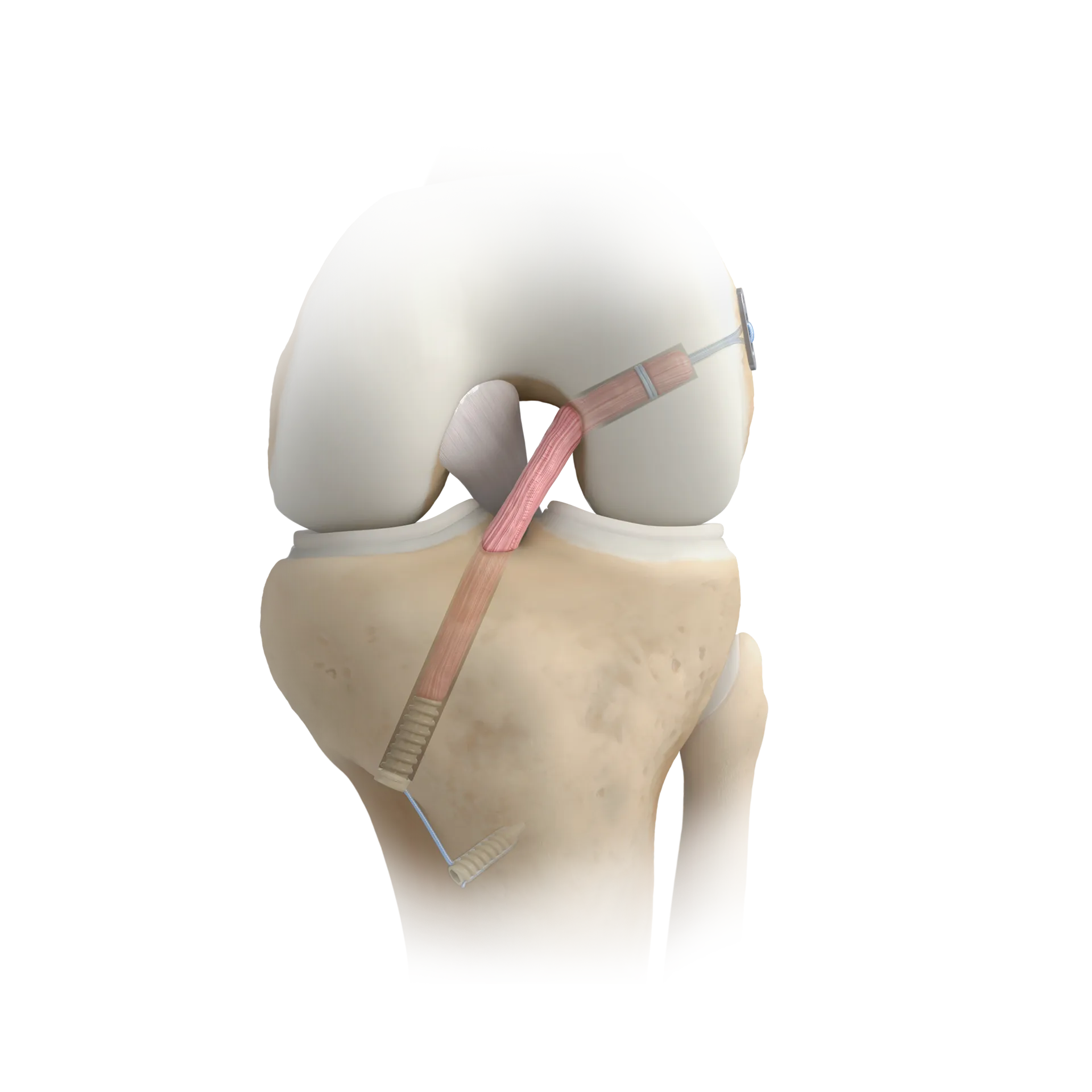 SSH09-前交叉韧带传统重建+栓桩固定-TRADITIONAL CRUCIATE LIGAMENT RECONSTRUCTION.png