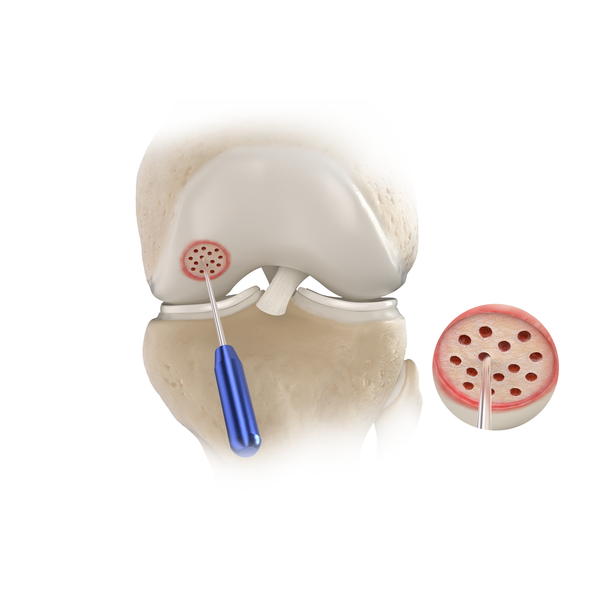 Microfracture Surgery-SINOAR